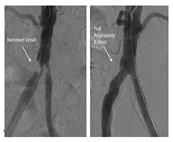 Ballon dilatation of the artery (Angioplasty)
